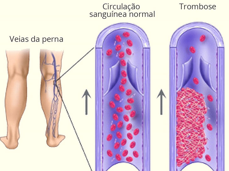 ARTIGO – Trombose e embolia pulmonar: a mobilidade como prevenção