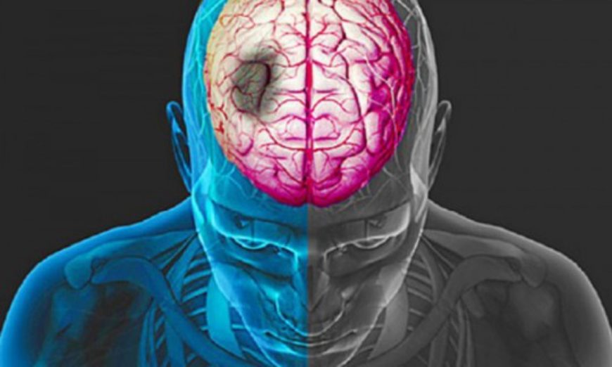 ARTIGO – Acidente Vascular Encefálico e Reabilitação