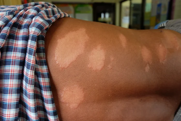 Janeiro Roxo: conscientização e combate à hanseníase